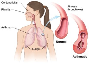 asthma