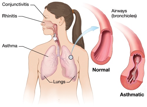 asthma